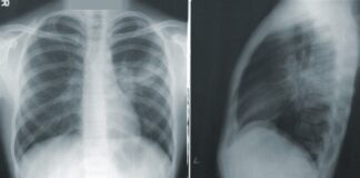 zatorowość płucna