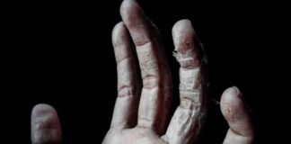 łojotokowe zapalenie skóry