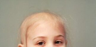 łysienie plackowate