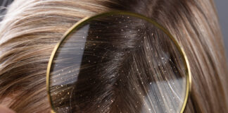 Łupież a wypadanie włosów