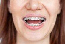 Pierwszy dzień z aparatem ortodontycznym – czego się spodziewać? aparat na zęby